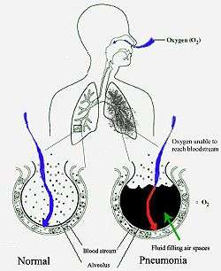 insan akciğerlerinin şematik bir çizimi. Soldaki boş daire normal bir alveolü ve sağdaki sıvıyla dolu olan pnömonili bir alveolü temsil ediyor.
