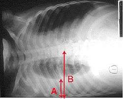 Yatay uzanan göğsü gösteren bir röntgen. Sağ akciğer olan alttaki siyah alan daha küçüktür ve altında pulmoner efüzyonu gösteren beyaz bir alan bulunmaktadır. Bunların büyüklüklerine işaretleyen kırmızı oklar bulunmaktadır.